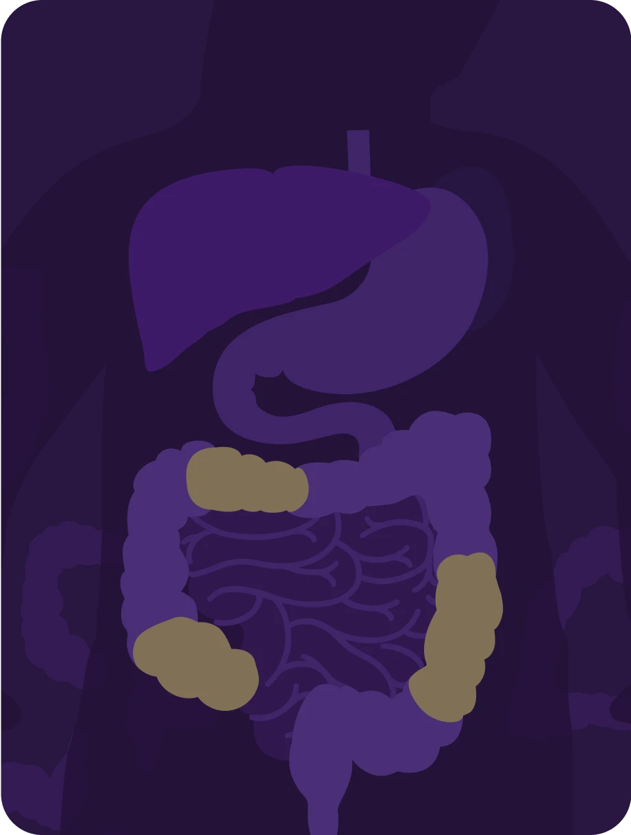 Crohn’s disease | Symptoms, Genetic Testing