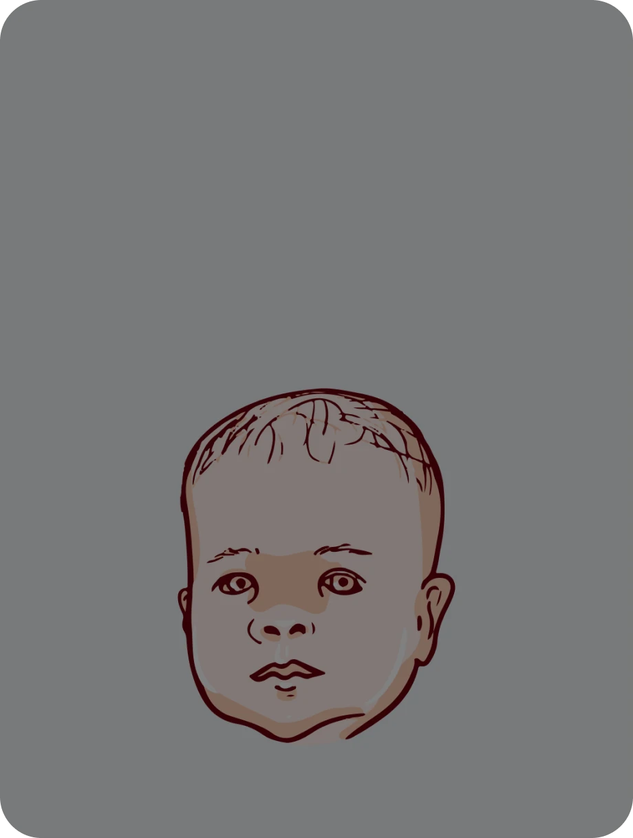 Noonan Syndrome | Karyotype and Genetic testing