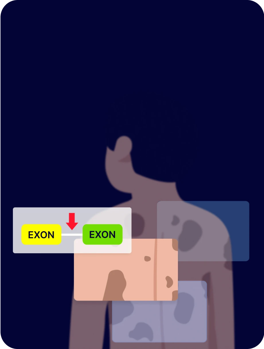 제1형 신경섬유종증 NF1 인트론 진단 사례