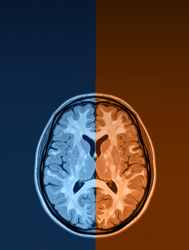 Episode 13: CADASIL vs. CARASIL: What Differs in Genetic Interpretation?