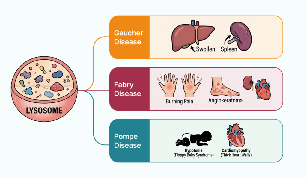 Diagram of lysosomal storage diseases: Gaucher with swollen spleen, Fabry with burning pain and angiokeratoma, Pompe with floppy baby syndrome and cardiomyopathy