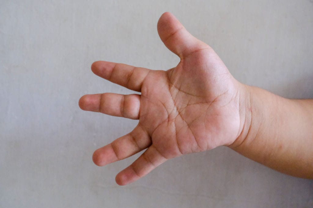 Achondroplasia in Children: From the FGFR3 Mutation to Voxzogo, the First Targeted Therapy